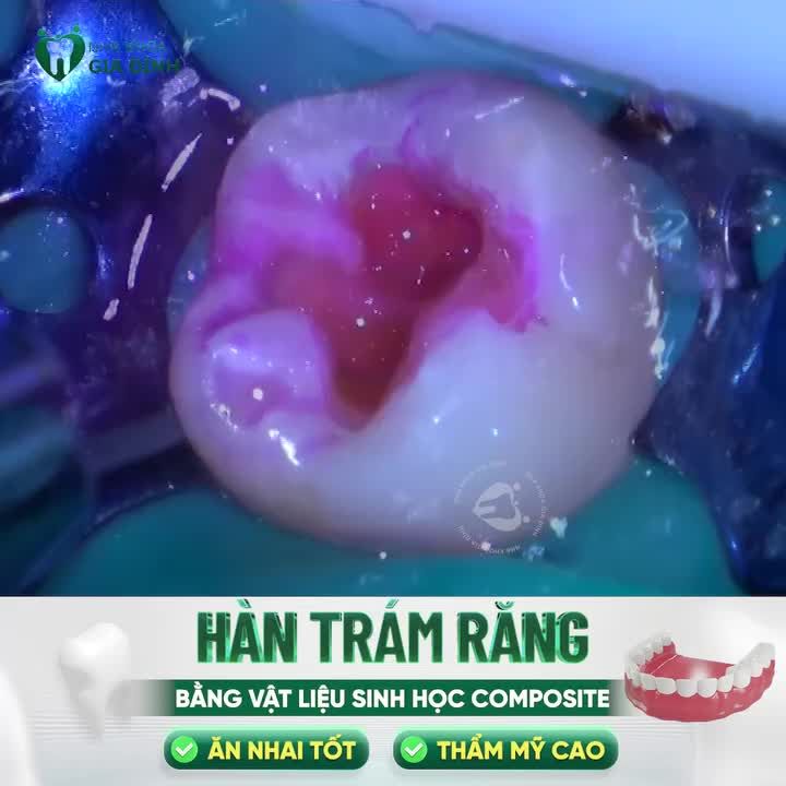 HÀN RĂNG BẰNG COMPOSITE SINH HỌC - ĂN NHAI TỐT, THẨM MỸ CAO