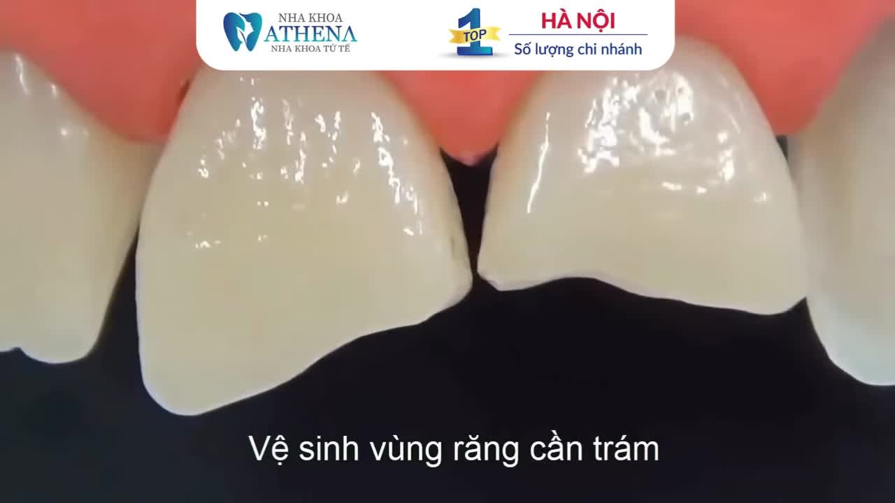BẠN ĐÃ BIẾT TRÁM RĂNG DIỄN RA THẾ NÀO CHƯA?