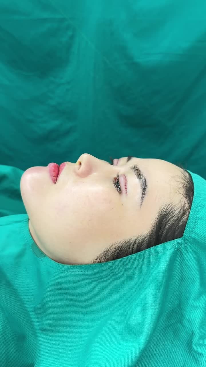 Sau 90 phút nếp mí tròn đều, to đẹp, sắc nét.