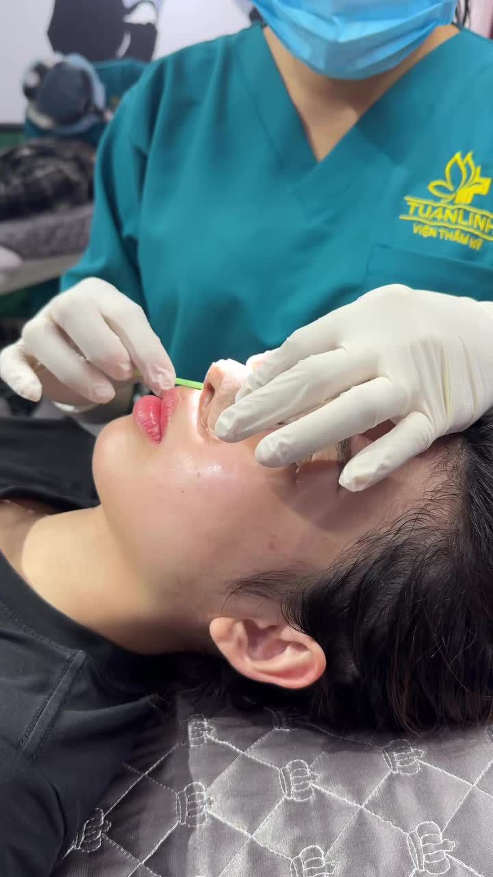 Nâng mũi cấu trúc - Dáng mũi sau 10 ngày tháo nẹp!!