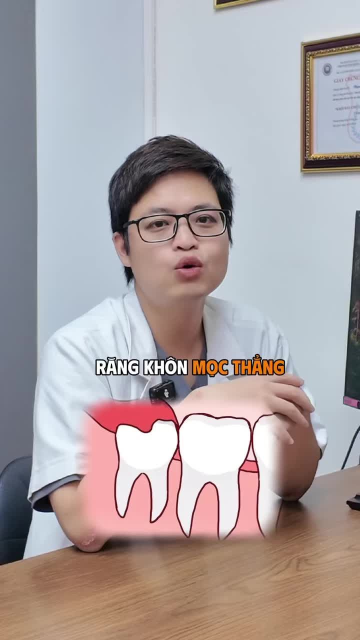 Răng khôn mọc thẳng – tưởng là “ngoan hiền” nên để lại?