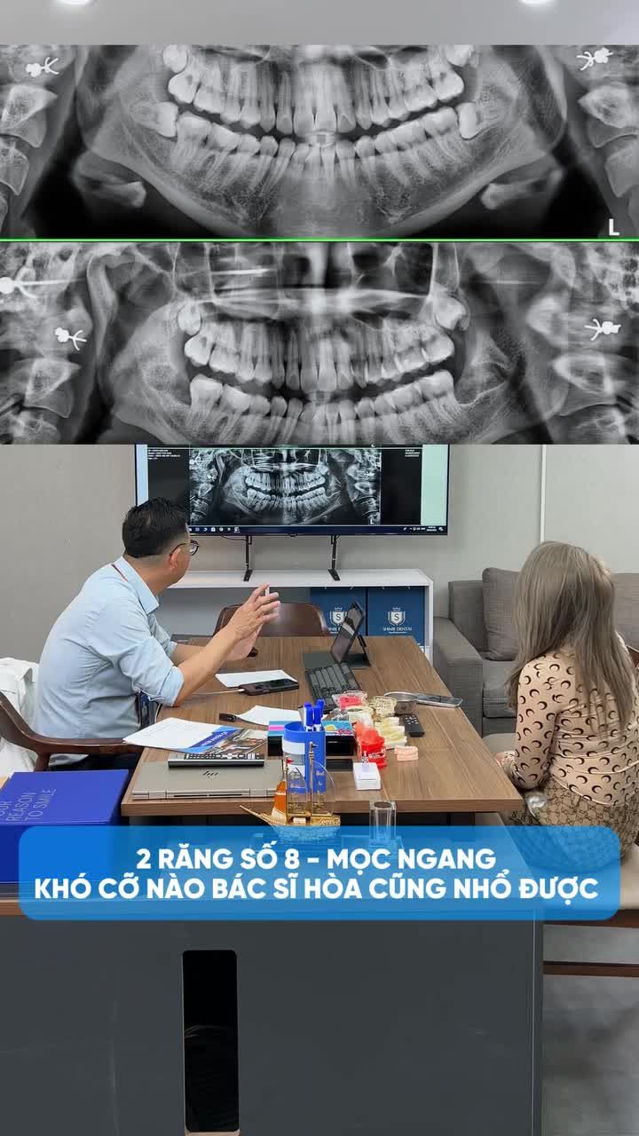 NHỔ 2 RĂNG SỐ 8 MỌC NGANG KHÓ.
