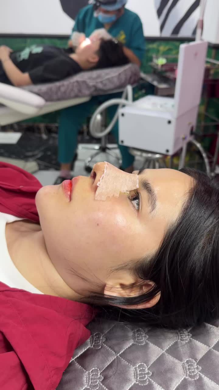 Case mũi cấu trúc được 5 ngày