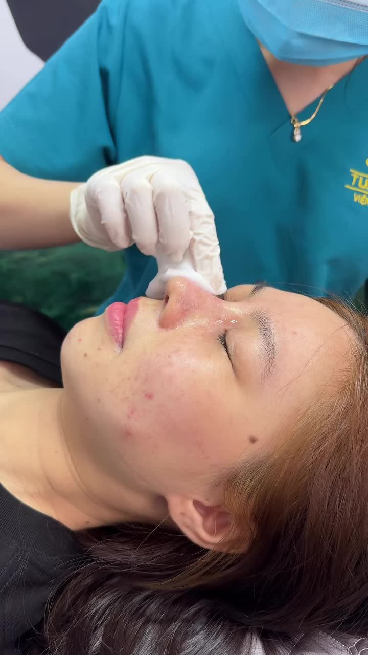 CA NÂNG MŨI CẤU TRÚC ĐƯỢC 10 NGÀY