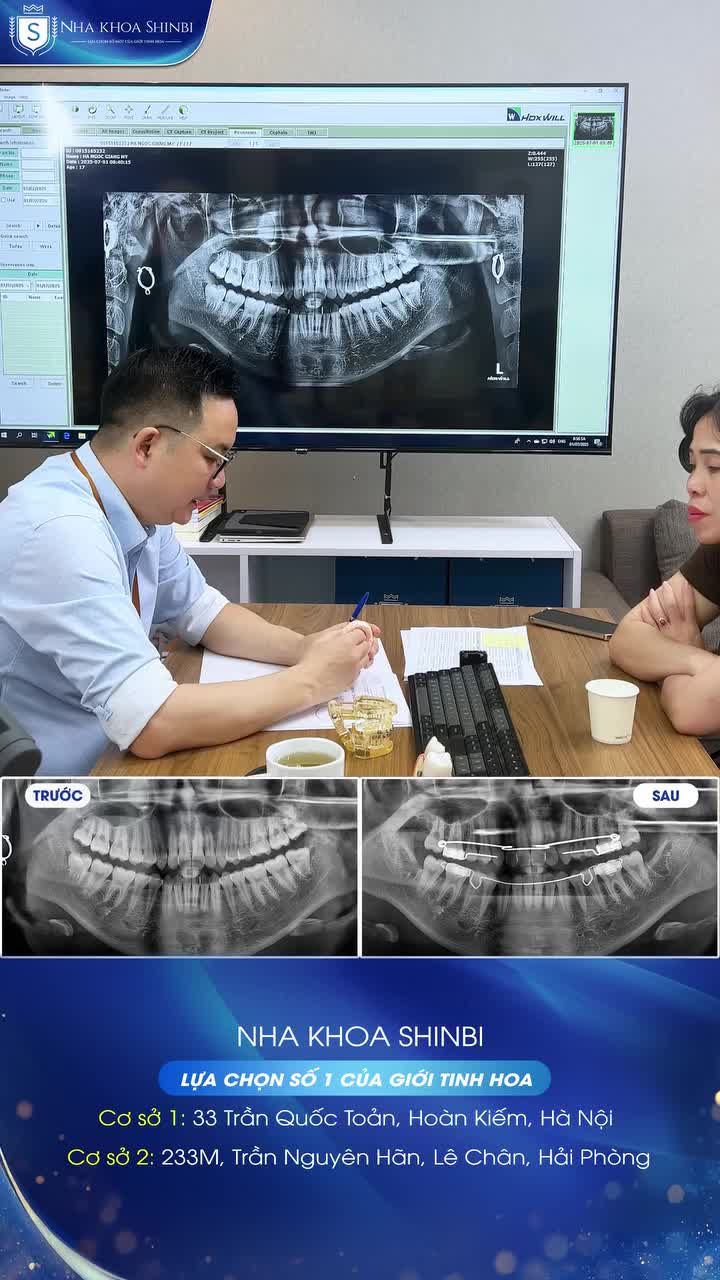 Niềng răng mắc cài tự động – Giải pháp cho hàm hẹp