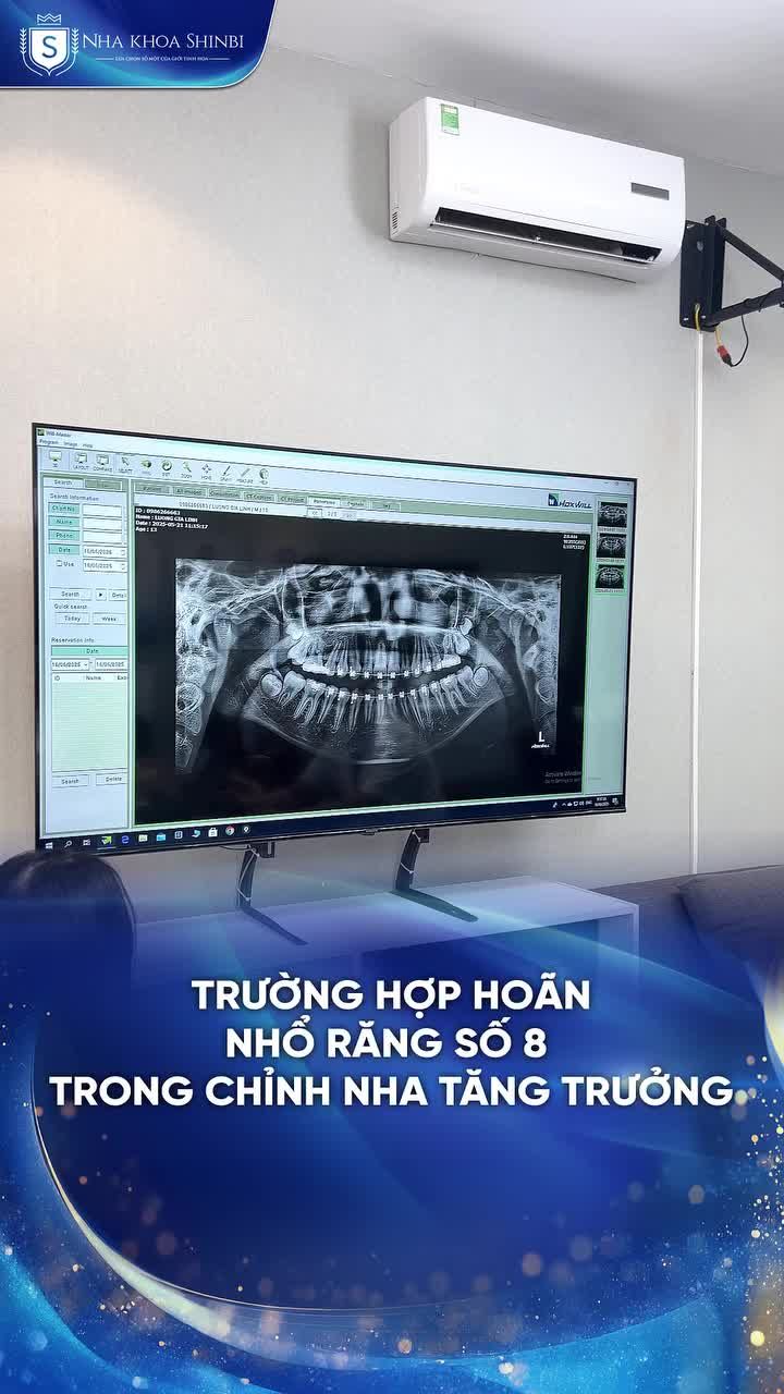 TRƯỜNG HỢP HOÃN NHỔ RĂNG SỐ 8 TRONG CHỈNH NHA TĂNG TRƯỞNG