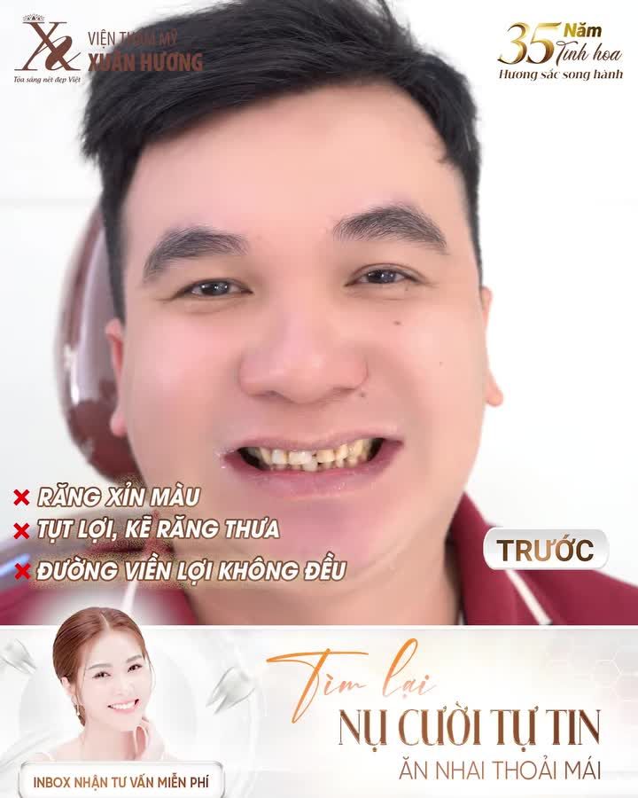 TÌM LẠI NỤ CƯỜI TỰ TIN – ĂN NHAI THOẢI MÁI