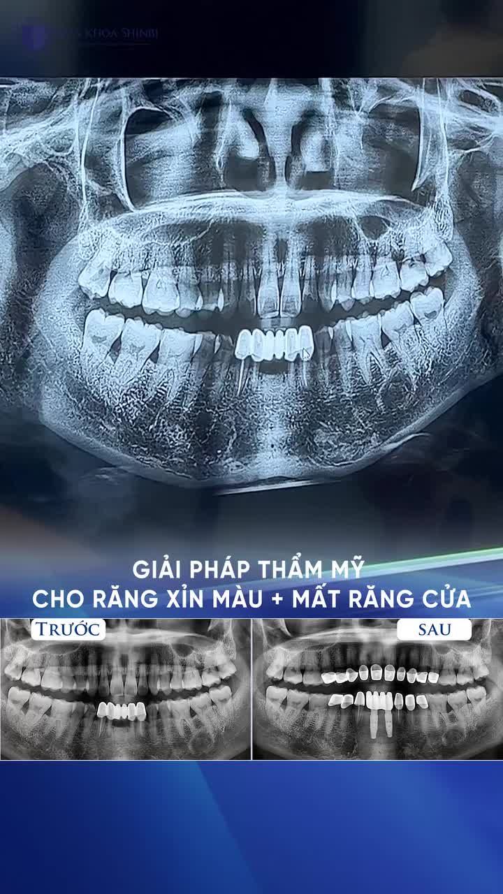GIẢI PHÁP THẨM MỸ CHO RĂNG XỈN MÀU VÀ MẤT RĂNG CỬA