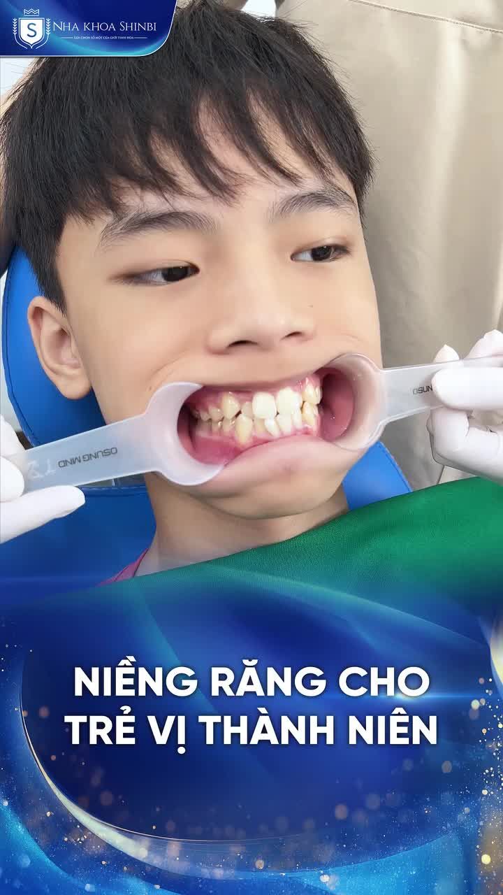 CHỈ ĐỊNH NIỀNG RĂNG CHỈNH NHA CHO TRẺ EM
