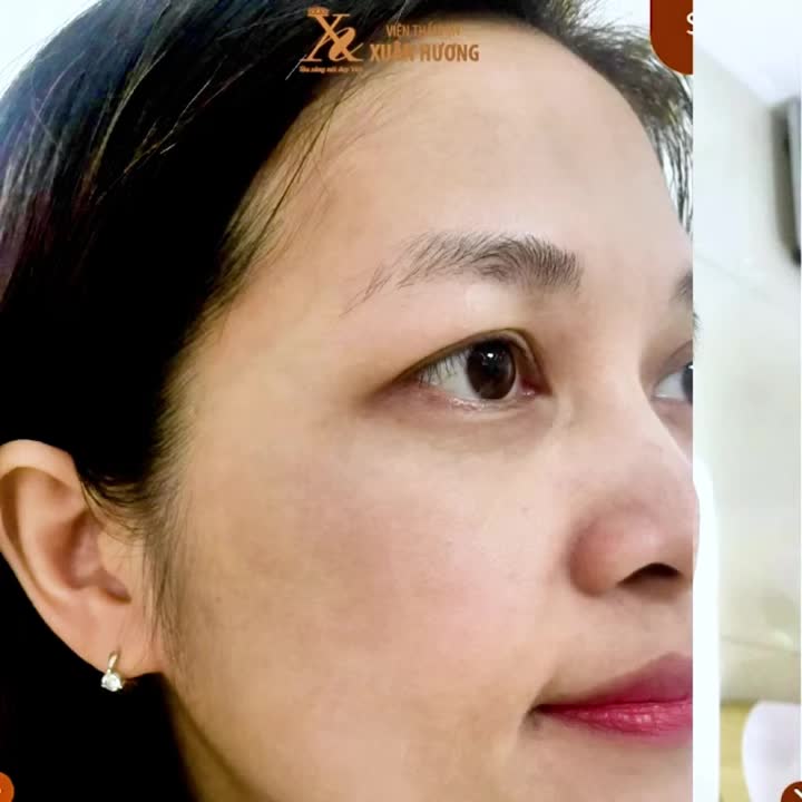 Trị nám Melas Picosure – Liệu trình rút gọn, sạch nám an toàn