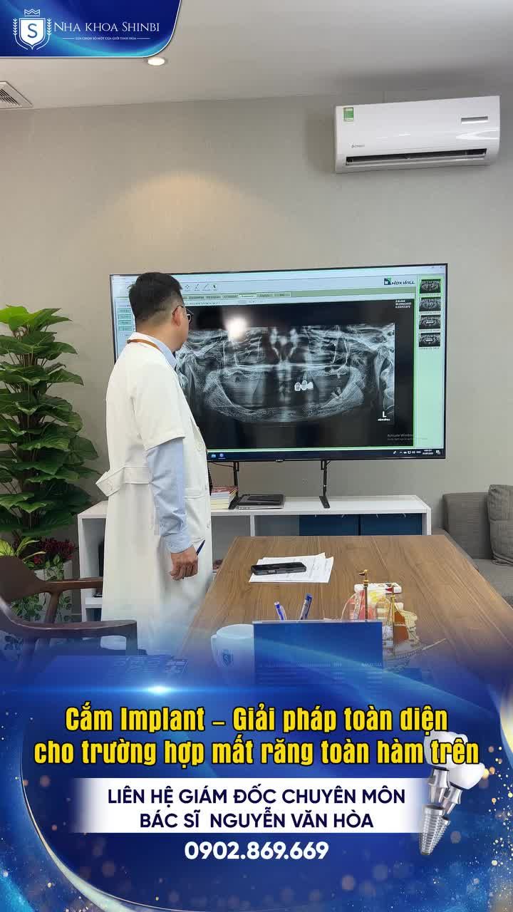 Giải pháp cho người mất răng hàm trên – cấy ghép implant