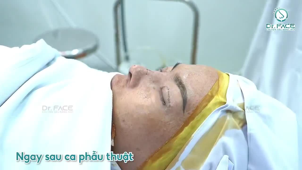 Tươi Trẻ Tức Thì Với Combo Nâng Mũi Sụn Sườn và Cắt Mí Mắt