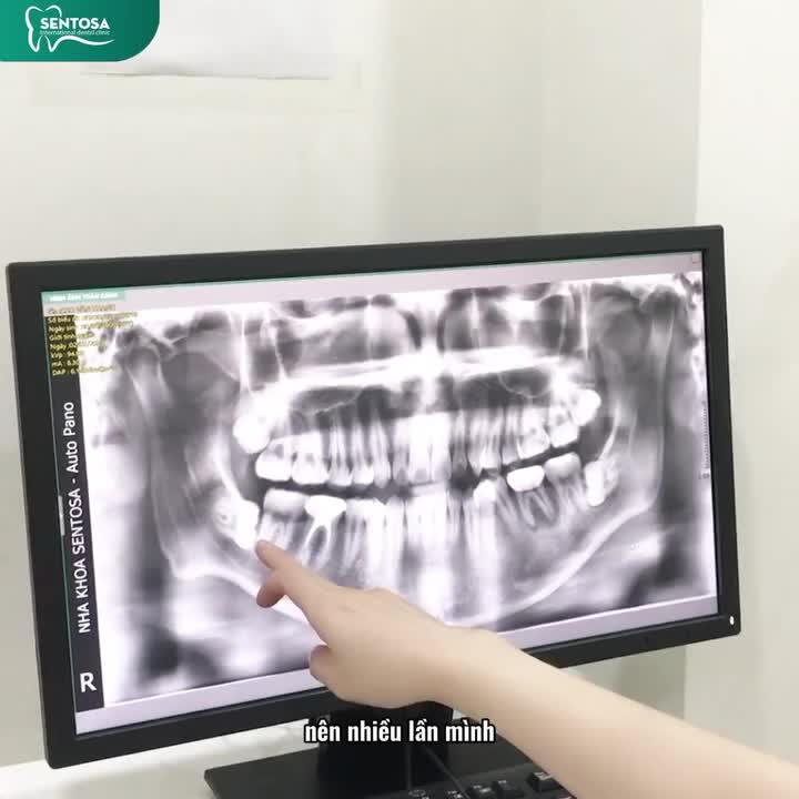 RĂNG KHÔN – NHỔ DỄ DÀNG, KHÔNG ĐAU VỚI CÔNG NGHỆ PIEZOTOME