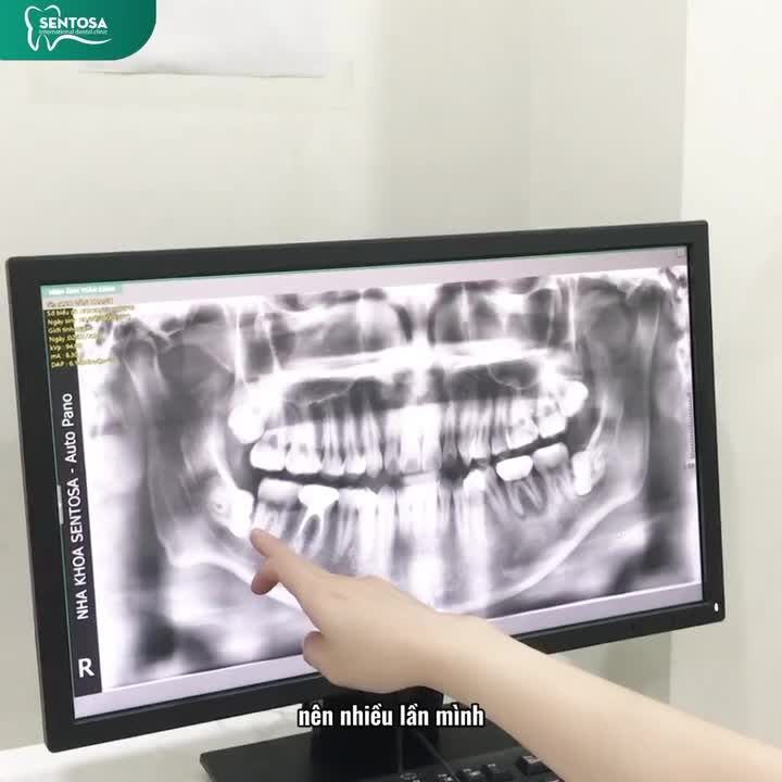 RĂNG KHÔN – NHỔ DỄ DÀNG, KHÔNG ĐAU VỚI CÔNG NGHỆ PIEZOTOME