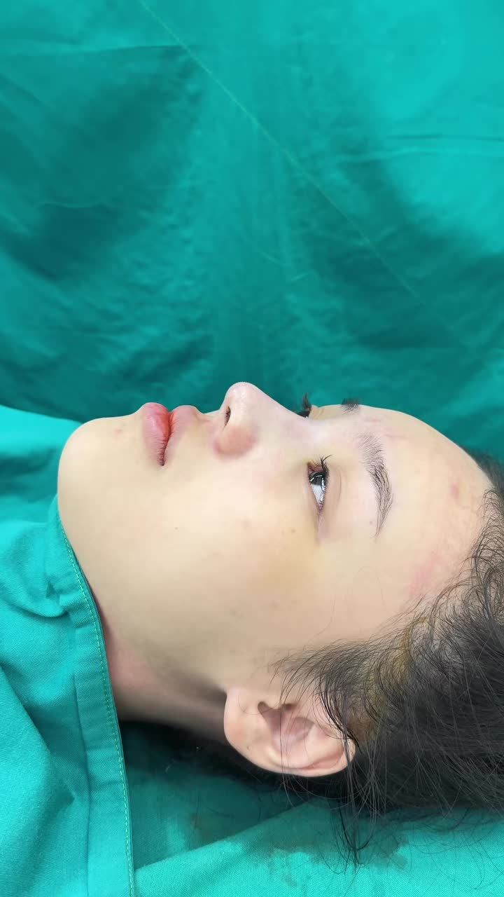 Case mũi bọc sụn vừa hoàn thành