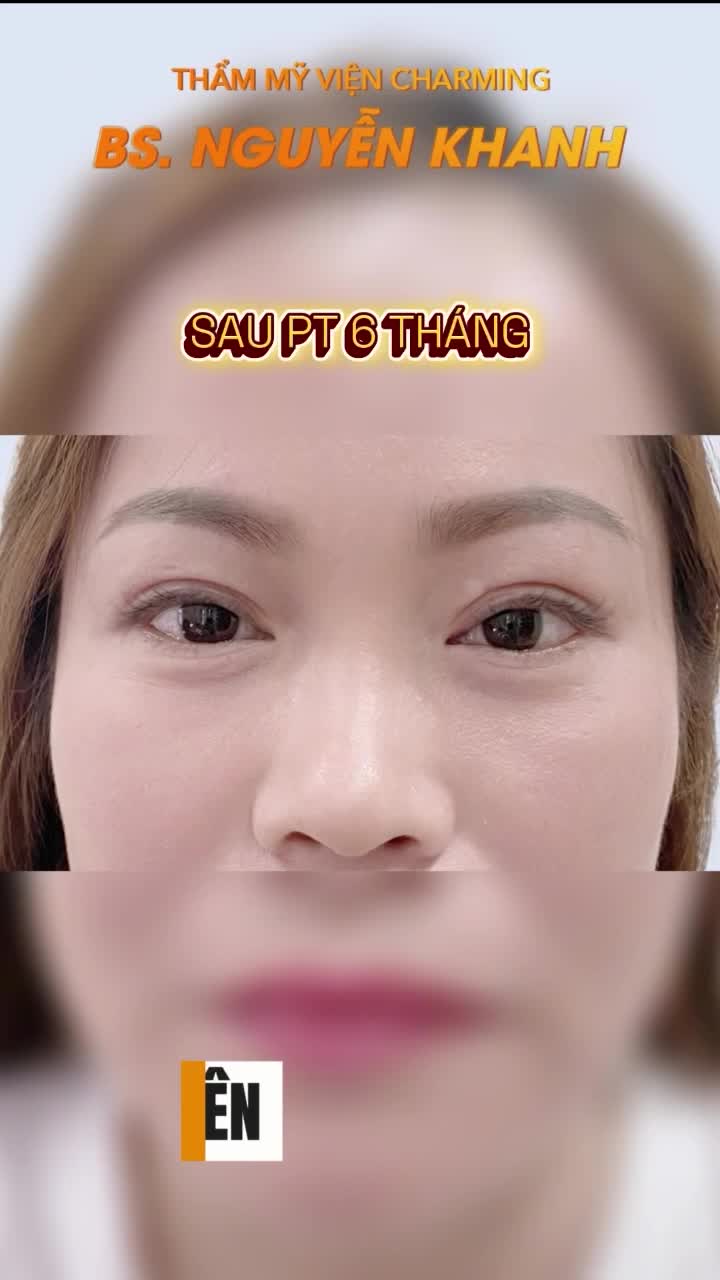 Trước phẫu thuật, phần mí trên của chị hơi sụp, còn mí dưới lại lộ rõ bọng mắt khiến gương mặt luôn trông mệt mỏi, thiếu sức sống.