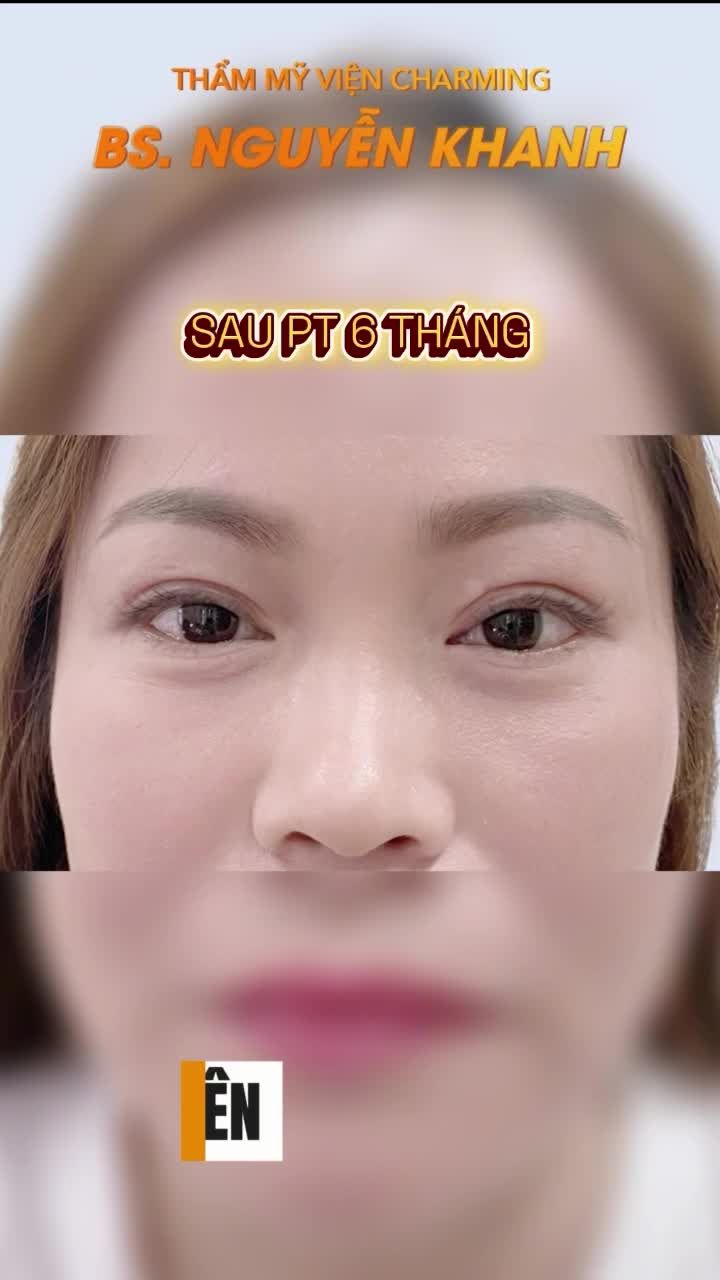 Trước phẫu thuật, phần mí trên của chị hơi sụp, còn mí dưới lại lộ rõ bọng mắt khiến gương mặt luôn trông mệt mỏi, thiếu sức sống.