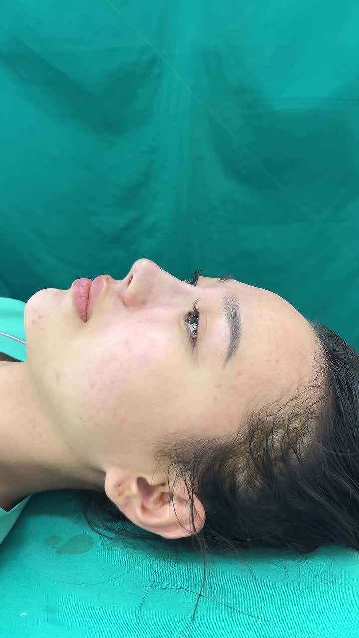 Case mũi bọc sụn vừa hoàn thành