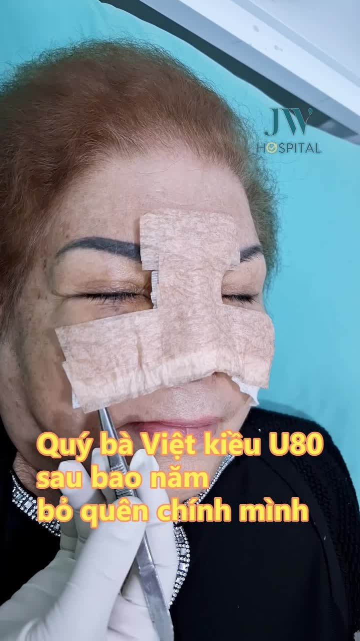 U80 CÓ NÊN THỰC HIỆN THẨM MỸ NÂNG MŨI KHÔNG?