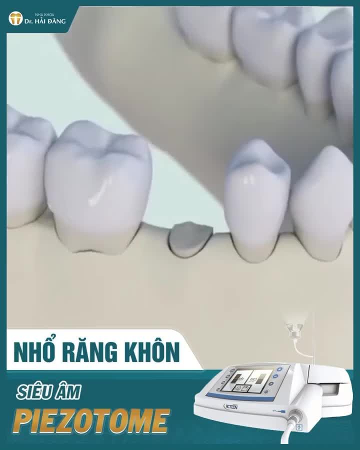 NHỔ RĂNG KHÔN MỌC LỆCH – AN TOÀN, NHẸ NHÀNG VỚI CÔNG NGHỆ MÁY HIỆN ĐẠI