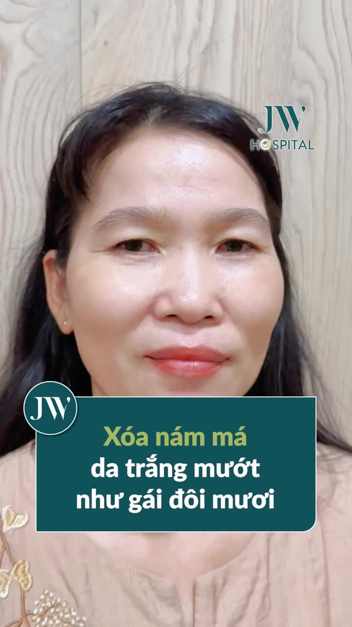 TẶNG U40 - U70 DA TRẮNG HỒNG NHƯ GÁI ĐÔI MƯƠI SAU ĐIỀU TRỊ NÁM