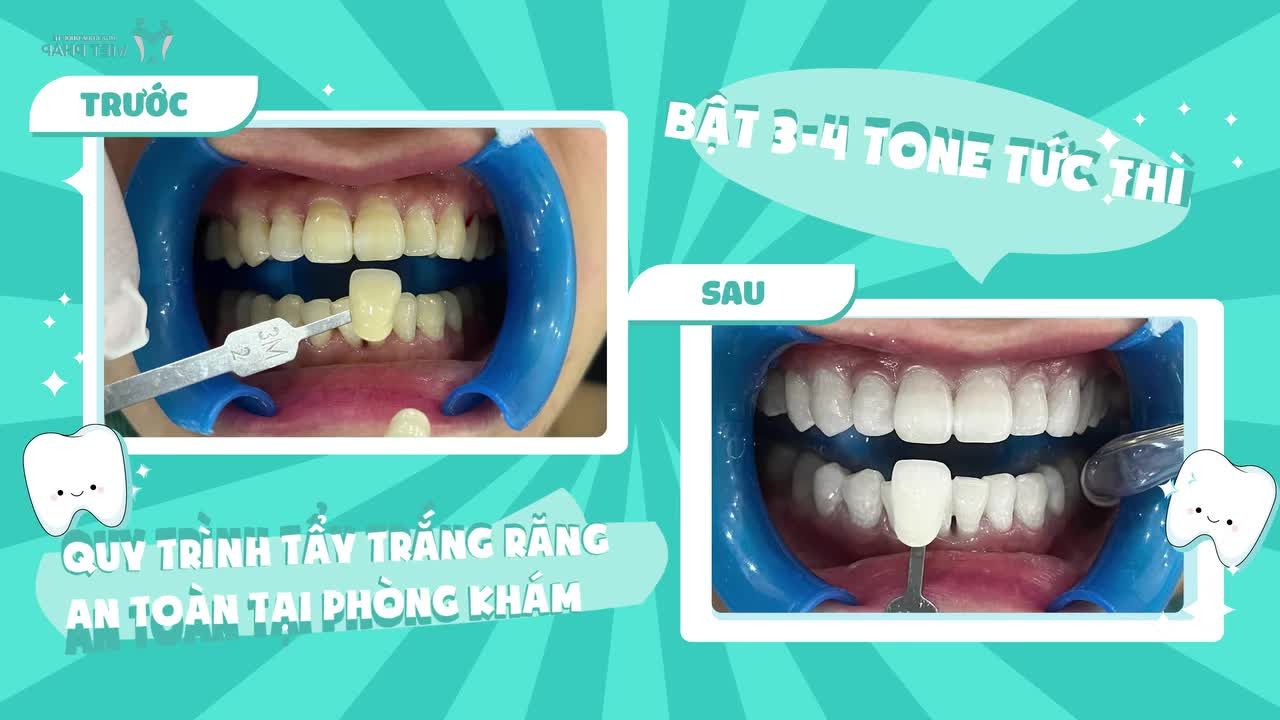 QUY TRÌNH TẨY TRẮNG RĂNG KHÔNG Ê BUỐT