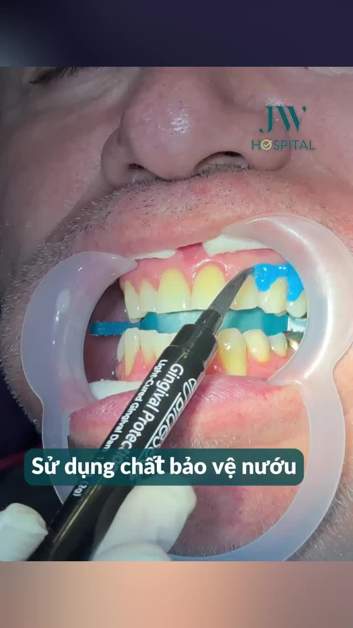 TẠM BIỆT RĂNG Ố VÀNG, XỈN MÀU CHỈ SAU 60 PHÚT TẨY TRẮNG RĂNG LED BLEACHING TẠI JW