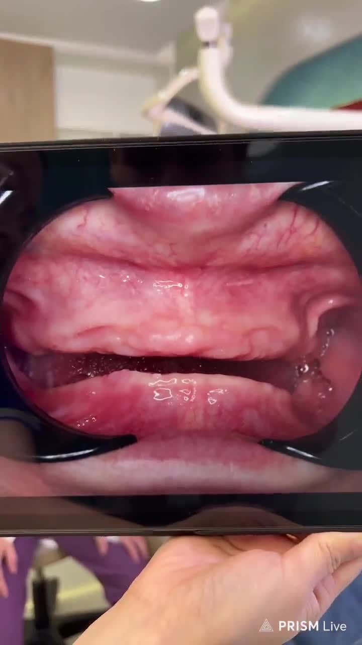 Bác sĩ JW hồi sinh nụ cười cho Việt kiều Mỹ U60 MẤT RĂNG TOÀN HÀM với TRỒNG RĂNG IMPLANT