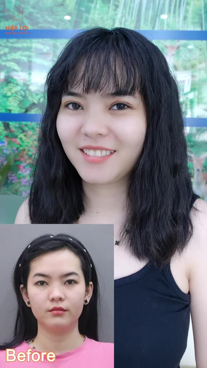 Tạm biệt mắt sụp mí, chào đôi mắt 2 mí to tròn tự nhiên.