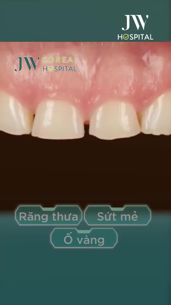 BỌC RĂNG SỨ TOÀN HÀM – NỤ CƯỜI ĐẸP SANG CHUẨN HÀN