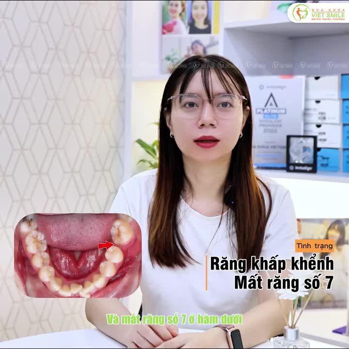 Niềng kéo răng – Lựa chọn thông minh thay thế răng mất