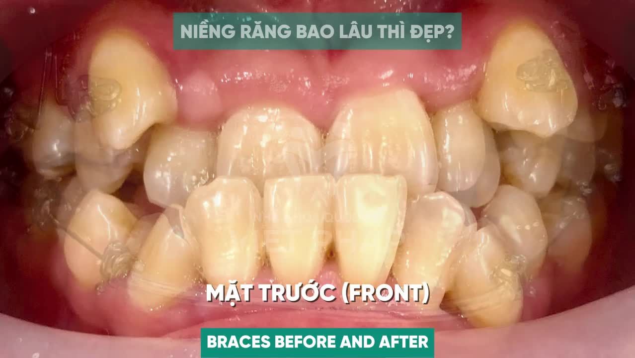 HÀNH TRÌNH 1 NĂM 10 THÁNG TẠM BIỆT MÓM, ĐÓN TỰ TIN