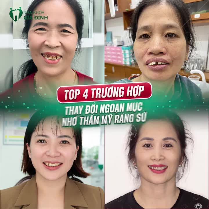 TOP 4 TRƯỜNG HỢP THAY ĐỔI RĂNG KHẤP KHỂNH NHỜ THẨM MỸ RĂNG SỨ