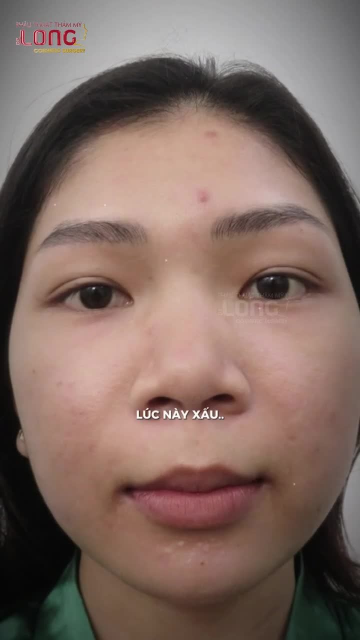 Khách nhà em nhan sắc phải nói là "Cực phẩm" sau combo nâng mũi, cắt cánh và nhấn mí mắt.