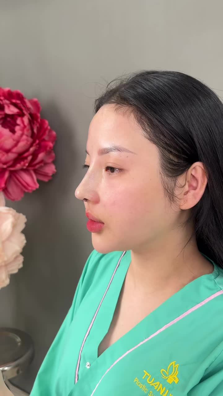 Case mũi cấu trúc surgiform vừa xong ạ