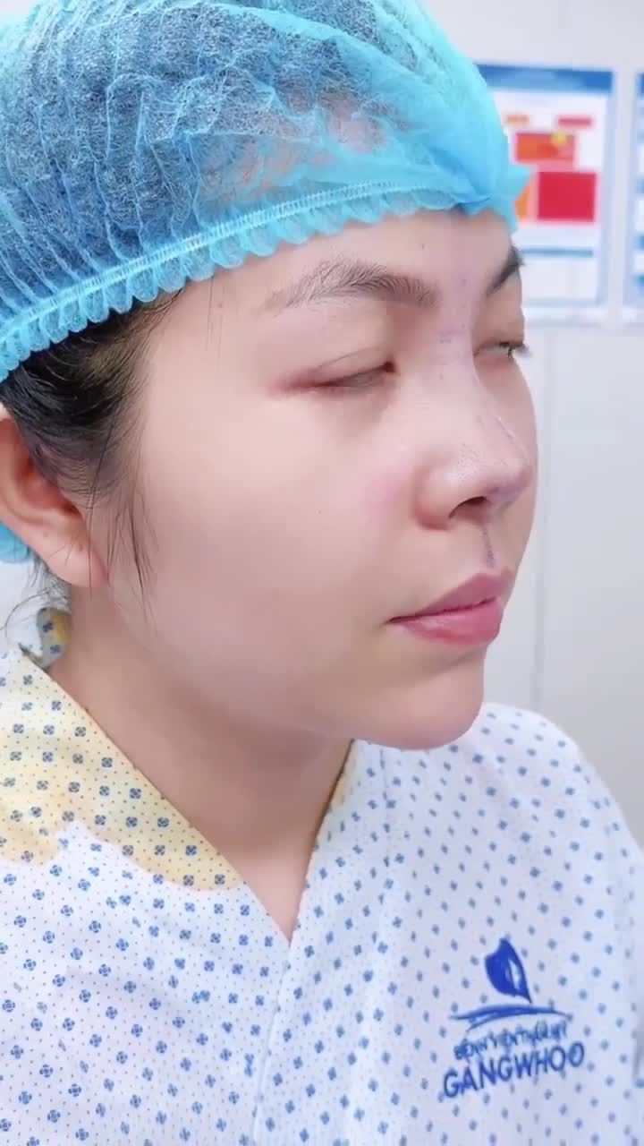 CÔ BẠN GEN Z SAU 1 NĂM ĐẮN ĐO, CUỐI CÙNG CŨNG THỰC HIỆN NÂNG MŨI CẤU TRÚC TẠI BVTM GANGWHOO
