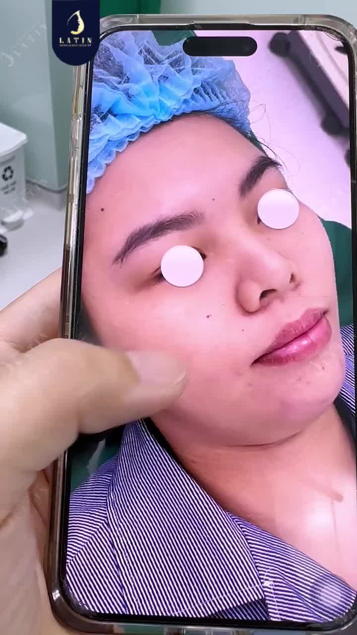 CẰM NGẮN, NỌNG NHIỀU – GIẢI QUYẾT SAU 45 PHÚT