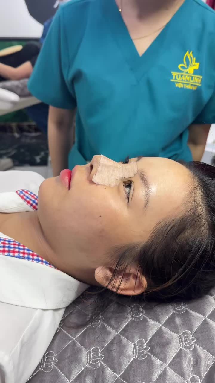Case mũi bán cấu trúc được 10 ngày