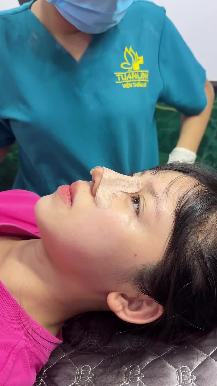CA NÂNG MŨI CẤU TRÚC ĐƯỢC 10 NGÀY