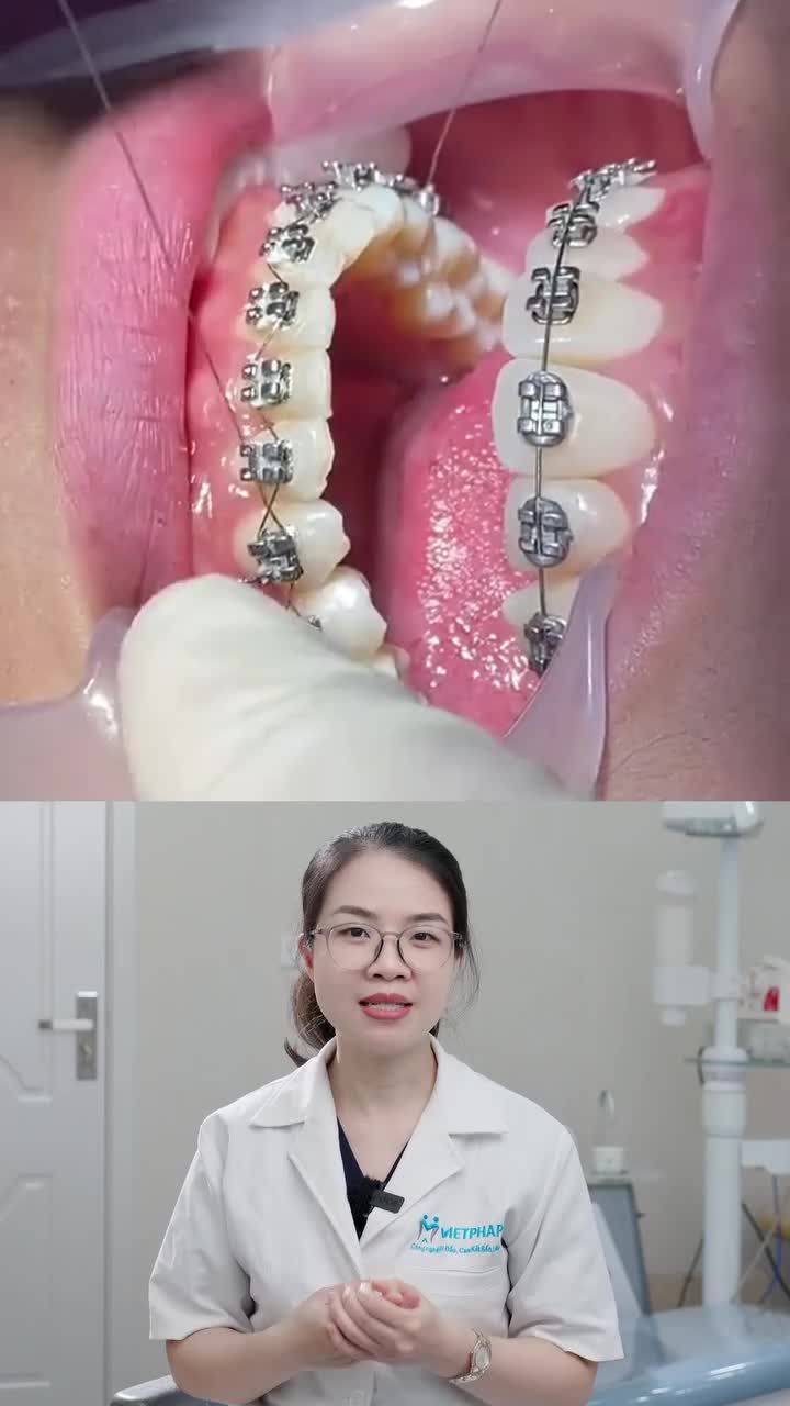 ĐI DÂY CUNG ZIGZAG KHI NÀO TRONG NIỀNG RĂNG!