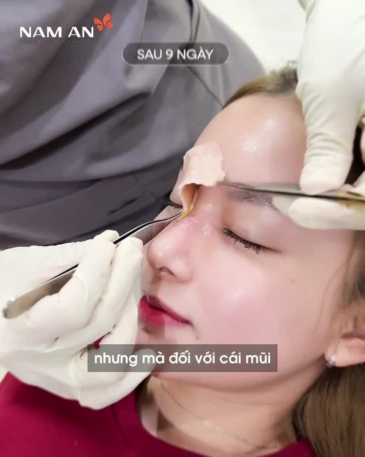 ÚT NHỊ "LỘT XÁC" VỚI DÁNG MŨI MỚI – CÓ ĐÁNG ĐỂ LÀM KHÔNG?