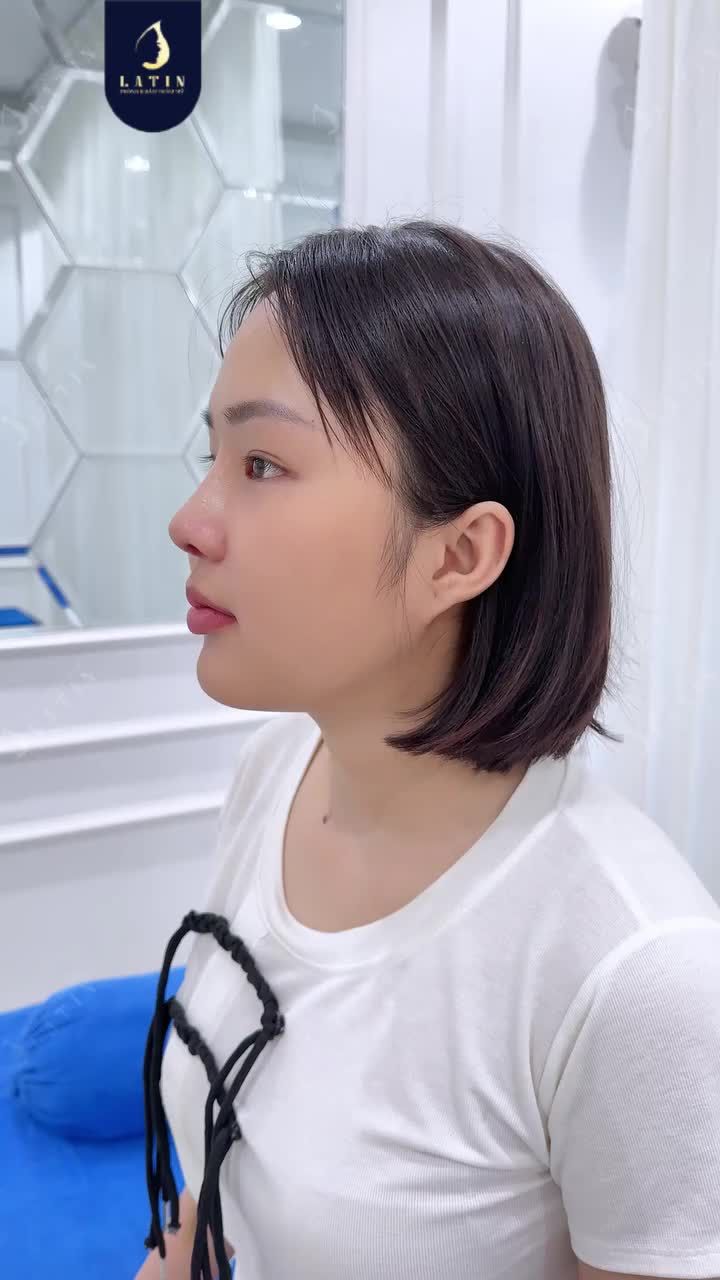 GƯƠNG MẶT NHỎ NHẮN – CẦN MỘT CHIẾC MŨI THANH THOÁT