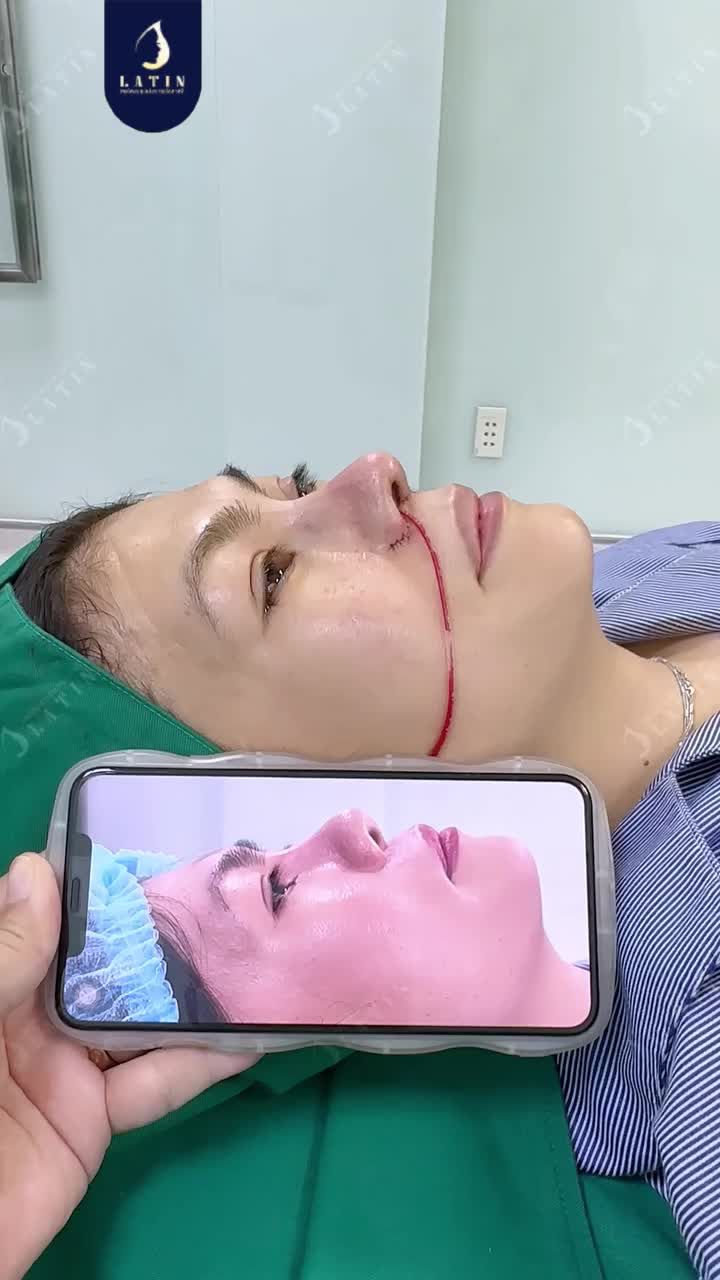 Chị khách từng nâng mũi bằng chất liệu nhân tạo cách đây 25 năm, nhưng thời gian khiến chiếc mũi bộc lộ nhiều khuyết điểm