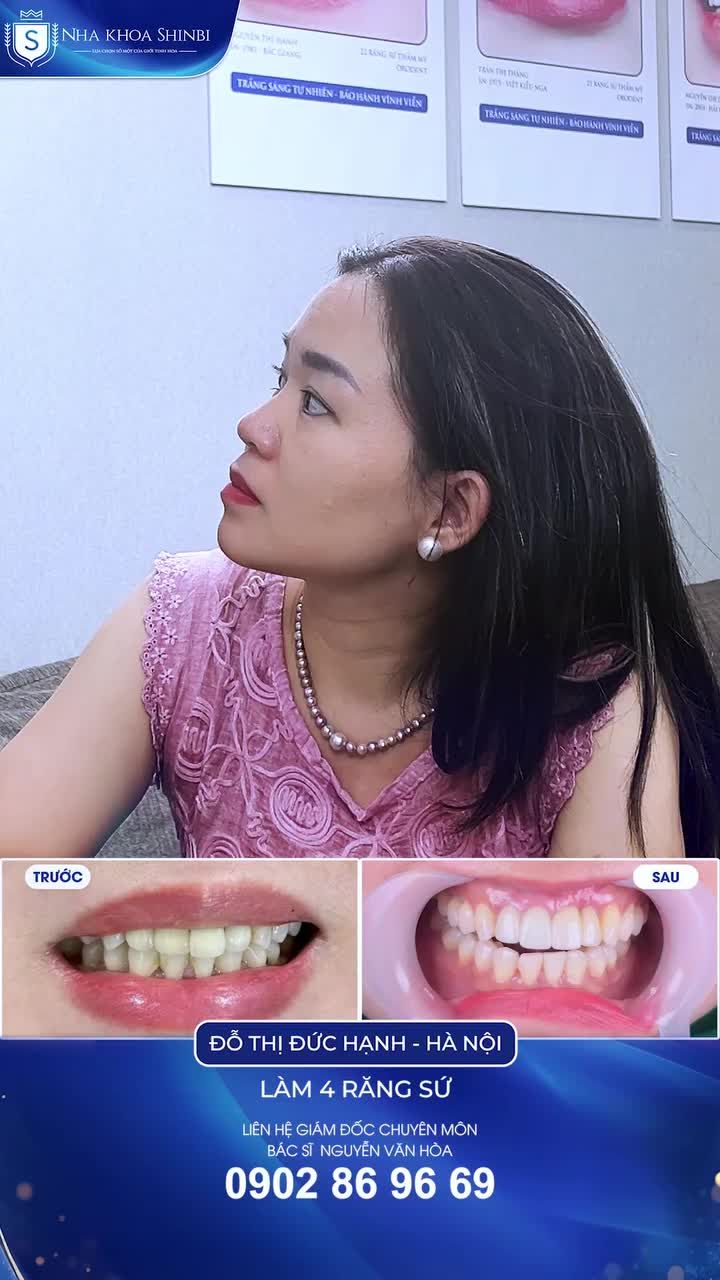 Chị khách hàng làm ở Bộ ngoại giao tin tưởng lựa chọn Shinbi để khắc phục tình trạng Răng sứ bị lỗi