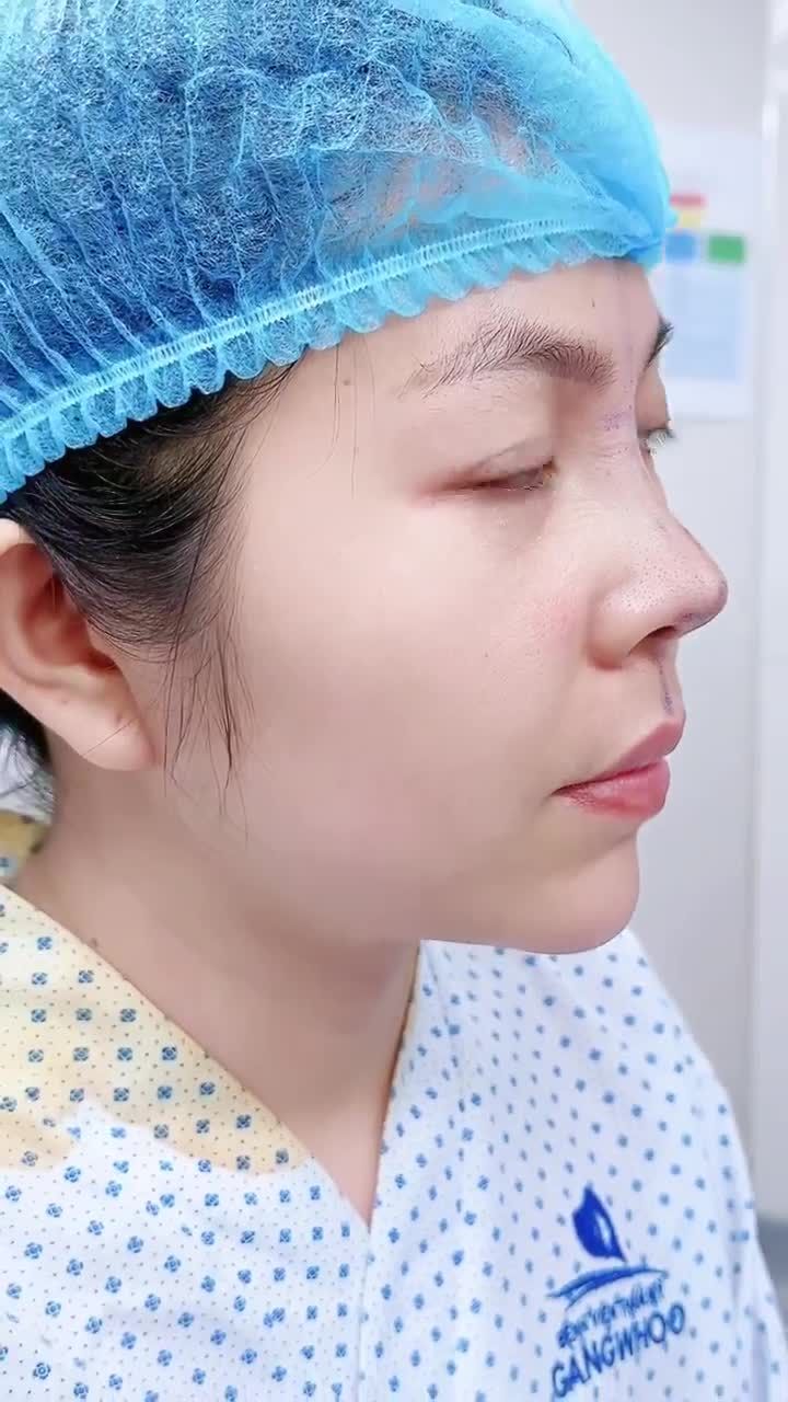 CHỊ T.M. LỘT XÁC VỚI NÂNG MŨI CẤU TRÚC 3D TẠI GANGWHOO – DÁNG MŨI THANH TÚ, DIỆN MẠO NỔI BẬT!