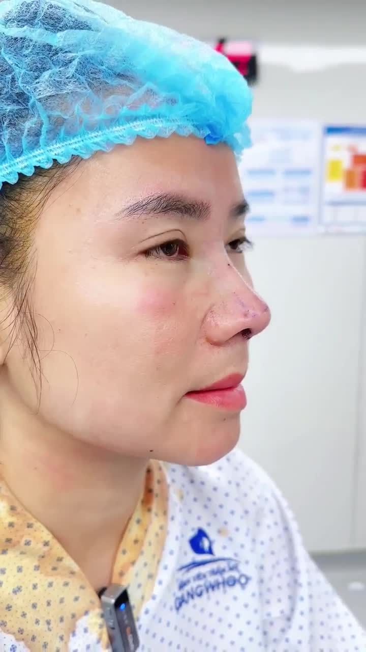 CHỊ T.M. LỘT XÁC NHAN SẮC CHỈ SAU 60 PHÚT NÂNG MŨI TẠI GANGWHOO – DÁNG MŨI THANH TÚ, GƯƠNG MẶT TỎA SÁNG!