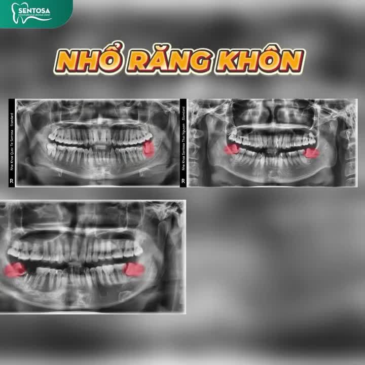 RĂNG KHÔN – ĐỪNG ĐỂ “KHÔN” MÀ LÀM KHỔ