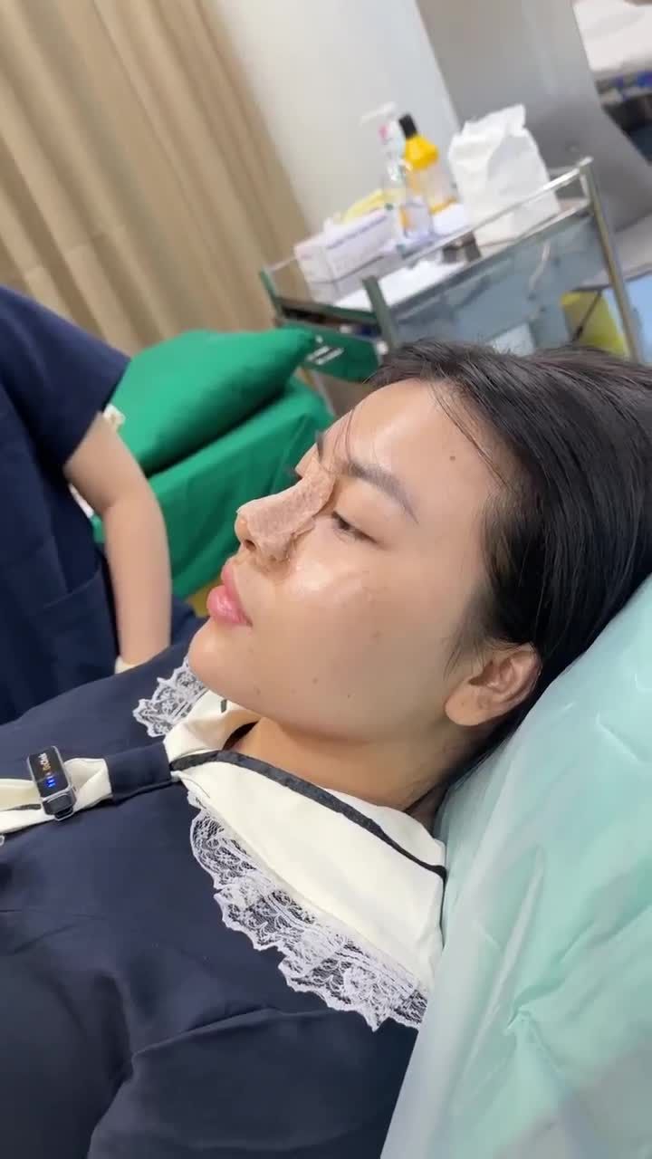 10 NGÀY THÁO NẸP CẮT CHỈ DÁNG MŨI SẼ RA SAO ?