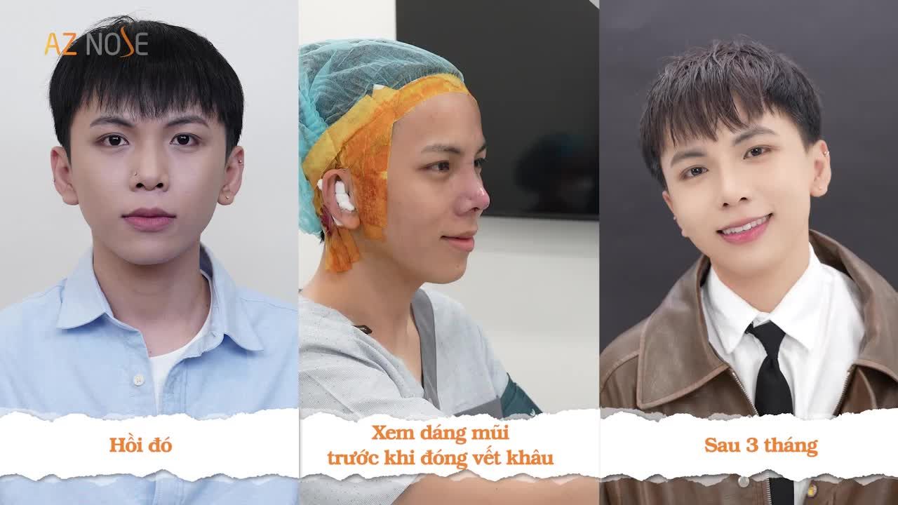 Dáng mũi Lline giúp gương mặt TikToker Phước Mê Skincare sáng hơn, hài hoà hơn và có chiều sâu ở từng góc nhìn