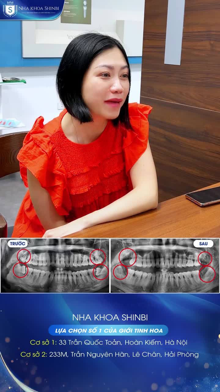 Nhổ 4 răng khôn cùng lúc chị khách hàng chia sẻ điều gì?